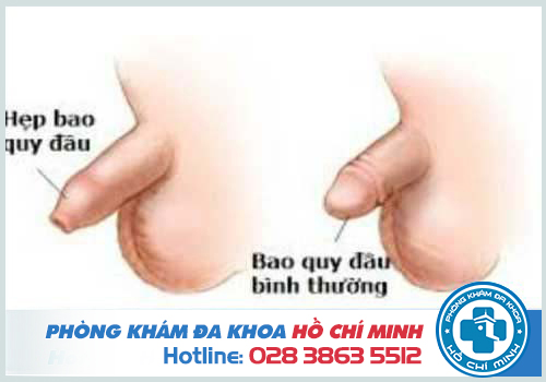 Cắt bao quy đầu có đau không? Có nguy hiểm không