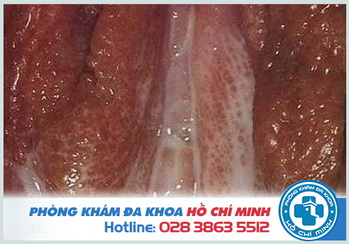 Chảy mủ ở bộ phận sinh dục nam và nữ