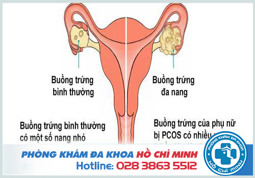 Nang buồng trứng gây hiện tượng có kinh sớm hơn 4 ngày