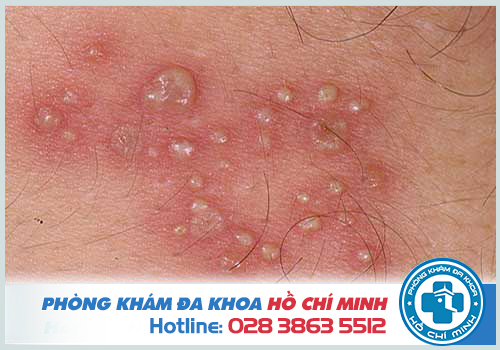 Hình ảnh bệnh xã hội do virus Herpes gây ra