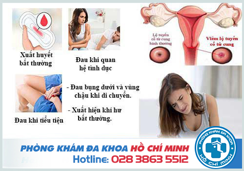 Triệu chứng viêm lộ tuyến cổ tử cung độ 4