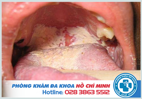 Quan hệ tình dục không an toàn là nguyên nhân gây bệnh kim la