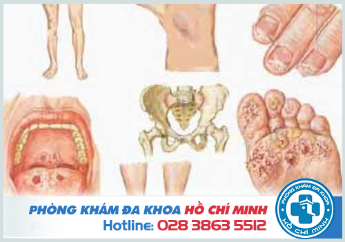 Bị bệnh lậu có quan hệ được không