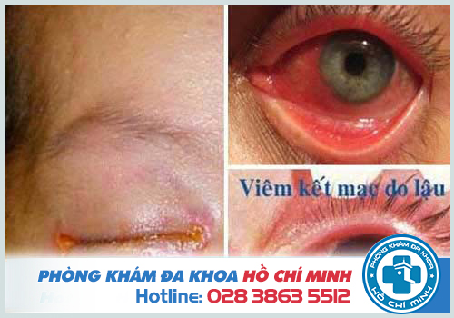 Bệnh lậu ở mắt có thể dẫn đến mù lòa