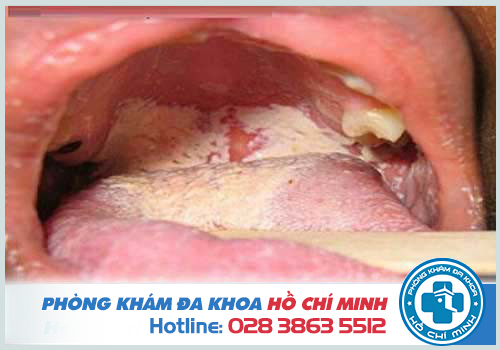 Hình ảnh bệnh lậu ở lưỡi và khoang miệng chi tiết nhất