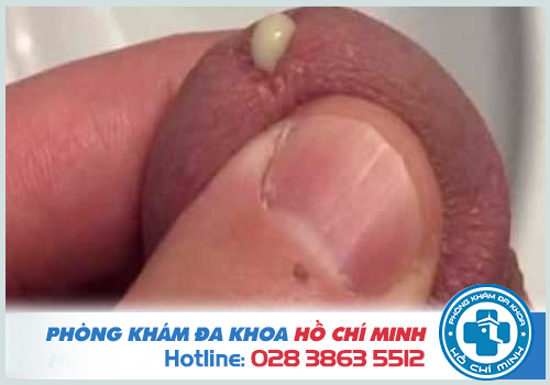 Hiện tượng sinh mủ ở niệu đạo khi mắc bệnh lậu