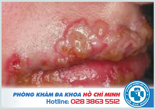 Hình ảnh Herpes tàn phá vùng da ở miệng