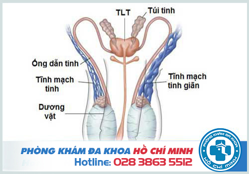 Tinh hoàn sưng do bị giãn mạch thừng tinh