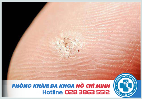 Bệnh sùi mào gà giai đoạn đầu có ngứa không?