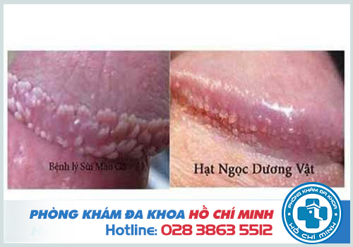 Hình ảnh đặc điểm các mụn sùi ở dương vật nam