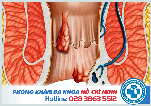 Thời gian điều trị bệnh trĩ bằng thuốc thường kéo dài