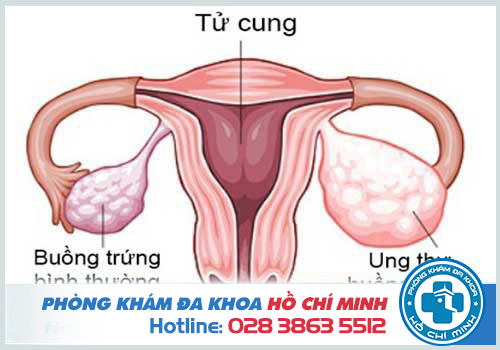 Hình ảnh bệnh phụ khoa u nang buồng trứng