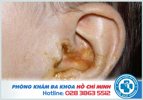 Bệnh viêm tai giữa có nguy hiểm không?
