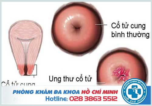 Sùi mào gà biến chứng có thể gây ung thư