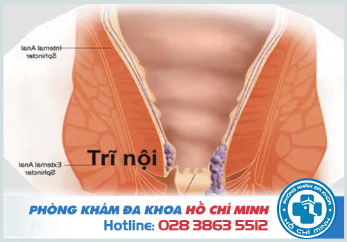 Bị bệnh trĩ có mang thai được không?