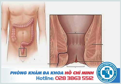 Lở loét hậu môn có là dấu hiệu của bệnh nứt kẽ hậu môn