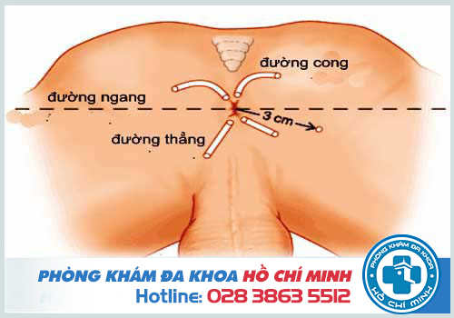 Hậu môn bị sưng và đau là do bệnh rò hậu môn