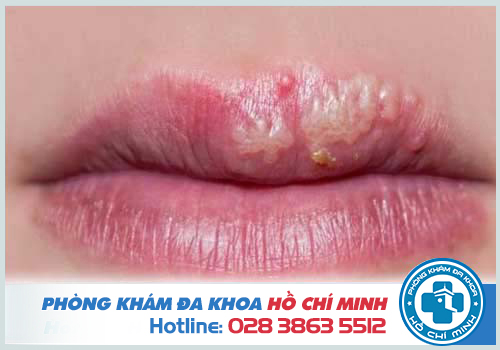 Mụn nước ở môi có thể là dấu hiệu của bệnh mụn rộp sinh dục