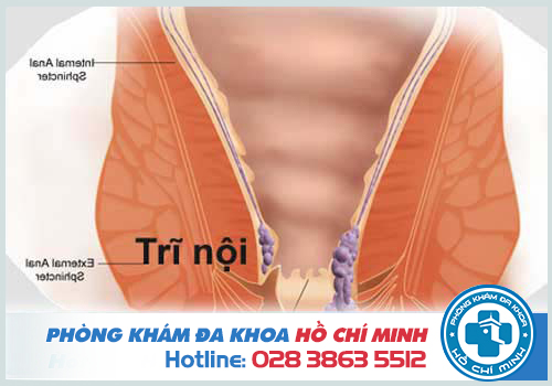 Cách chữa bệnh trĩ từ dân gian