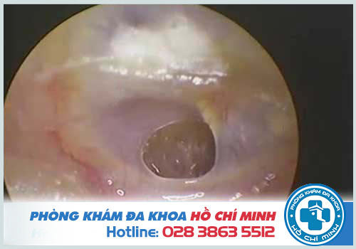 Viêm tai giữa có thể gây thủng màng nhĩ nếu không được chữa trị sớm