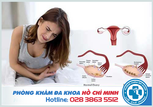 Chậm kinh 20 ngày là dấu hiệu của bệnh đa nang buồng trứng