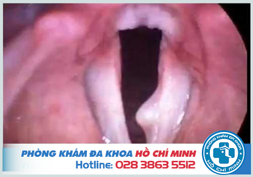 Chi phí cắt polyp thanh quản hết bao nhiêu tiền 2019 tùy vào tình hình sức khỏe