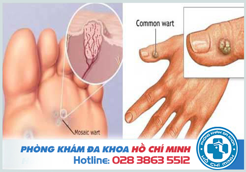Chi phí đốt mụn cóc bằng laser