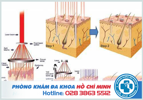 Chi phí đốt mụn cóc bằng laser hết bao nhiêu tiền