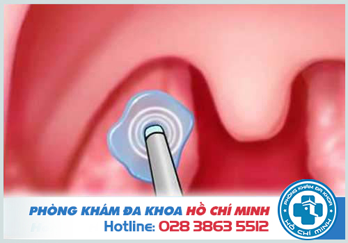 Chi phí đốt viêm họng hạt hết bao nhiêu tiền năm 2018