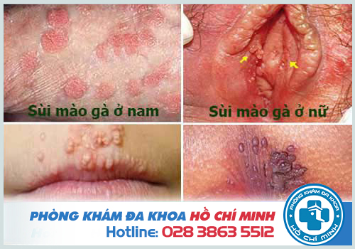 Chữa sùi mào gà bằng giấm táo