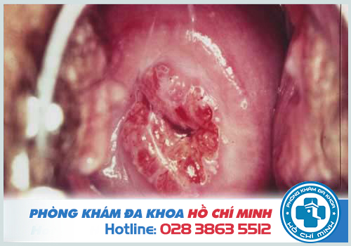 Biểu hiện của chuỗi hạt ngọc âm vật ở cổ tử cung