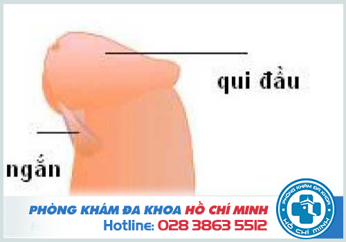 Có nên cắt dây hãm bao quy đầu