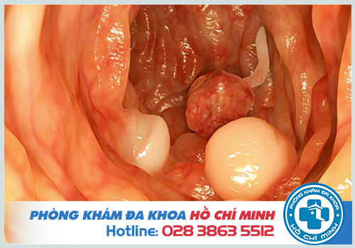 Có nên cắt Polyp hậu môn không