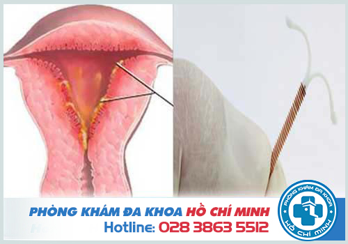 Đặt vòng tránh thai bị viêm nhiễm phải làm sao chữa trị