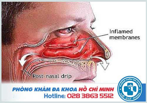 Đau rát họng kéo dài có thể là do viêm mũi xoang