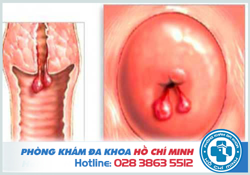 Đặc điểm của Polyp cổ tử cung