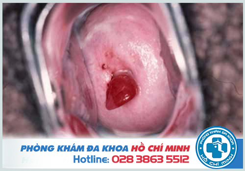 Polyp cổ tử cung gây xuất huyết âm đạo bất thường