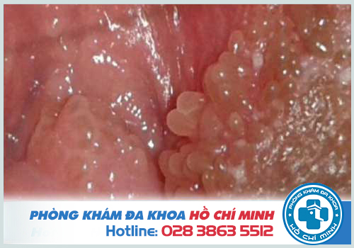 Gai sinh dục rất giông sùi mào gà