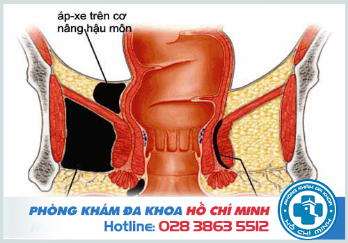 Hậu môn ẩm ướt có mùi hôi có thể là dấu hiệu của bệnh áp xe hậu môn