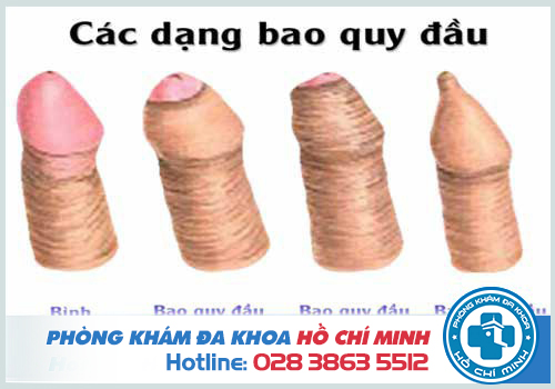 Hẹp bao quy đầu là gì