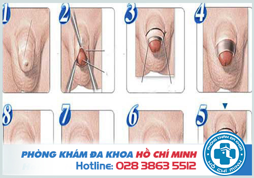 Hẹp bao quy đầu là gì và Dấu hiệu, triệu chứng của hẹp bao quy đầu