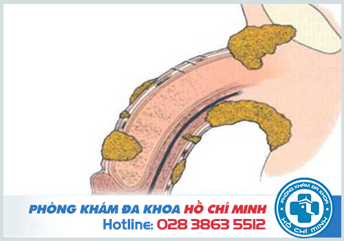 Hẹp bao quy đầu quan hệ có thai không có vô sinh không