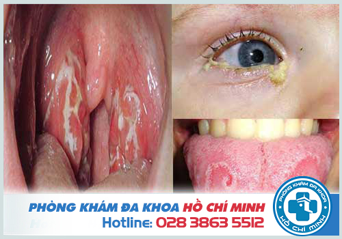 Hình ảnh về các dấu hiệu bệnh lậu ở lưỡi, họng và mắt chi tiết nhất