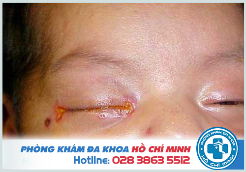 Hình ảnh bệnh lậu làm tổn thường mắt trẻ sơ sinh