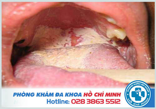 Hình ảnh bệnh lậu ở miệng qua từng giai đoạn gây hậu quả nghiêm trọng