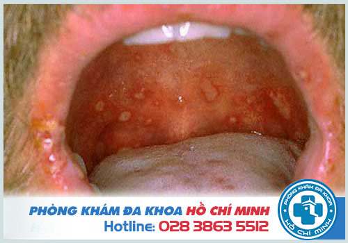 Hình ảnh bệnh lậu ở miệng qua từng giai đoạn