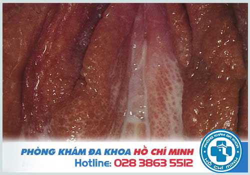 Hình ảnh bệnh lậu ở âm hộ của nữ