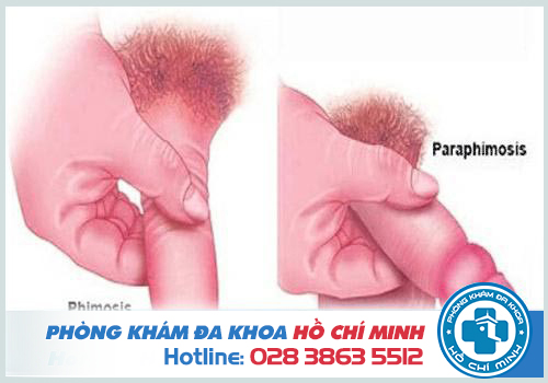Hình ảnh hẹp bao quy đầu ở nam giới