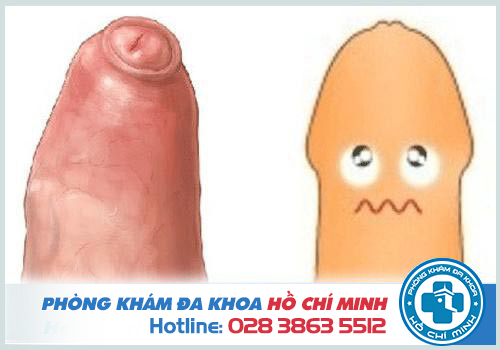 Hình ảnh dài bao quy đầu ở người lớn