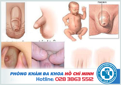 hình ảnh bao quy đầu hẹp